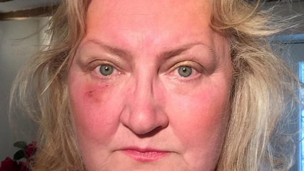 Güneş koruyucu kullanmasına rağmen gözlüğünün ışınları büyütmesi sonucu cilt kanseri