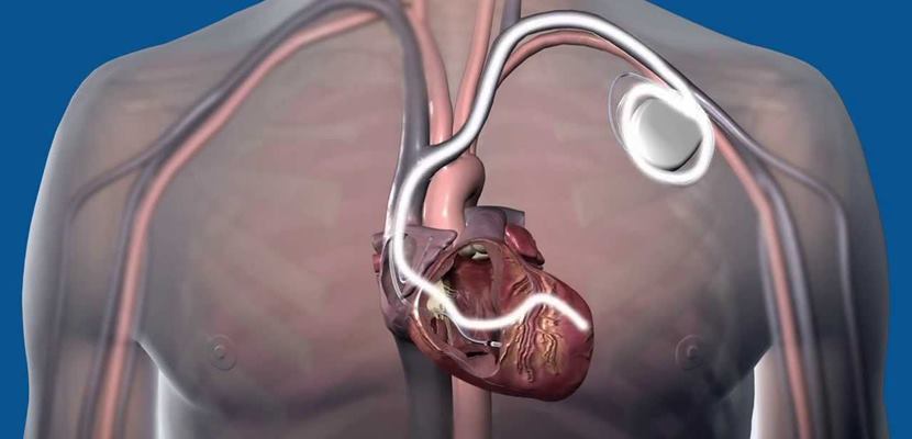 Genellikle yaşlı hastalara uygulanan kalp pili operasyonu bu kez 21