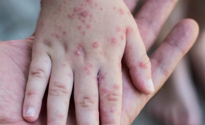 Isparta’nın Aksu ilçesinde bulunan okullarda el ayak hastalığı teşhisi konulan