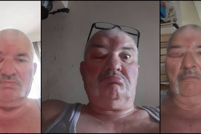 Isparta’da Sıcaklarla Birlikte Artan Tehlike: Sivrisinek Isırığı Göz Kapatabiliyor!